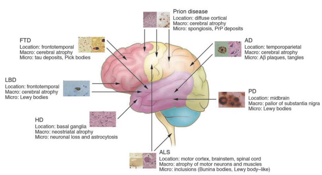 図2. 主な神経変性疾患の病変と病理の概要説明